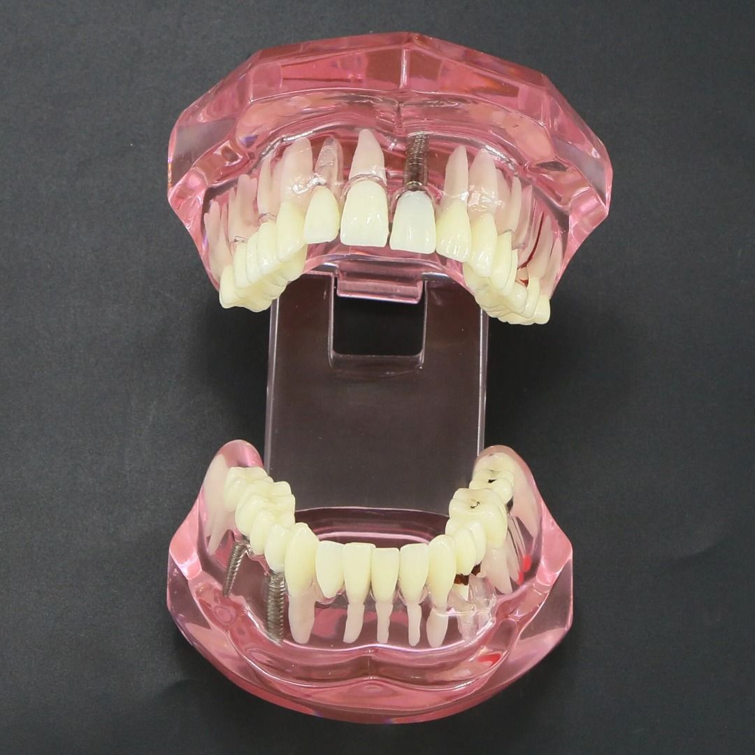 Dental Teeth Model Teaching Model Implant Disease Teeth Repair ...