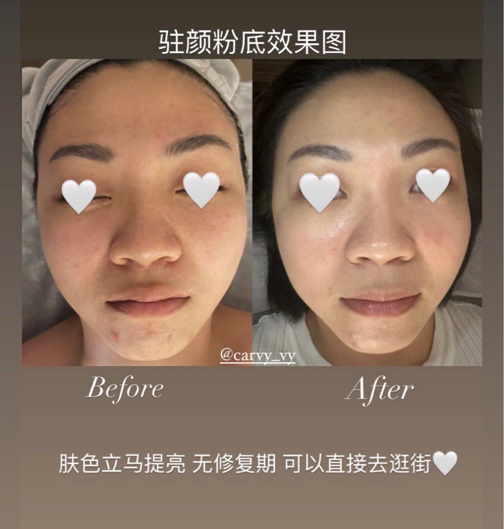 BB Glow Treatment 🤍 (Category: Beauty & Health Services) located in Singapore. Submitted by labellebeauty (Listing ID 1258503268, Image 1). Description: The BB Glow treatment is a cosmetic procedure that uses a semi-permanent tinted moisturizer adjusted to your skin tone to give the skin a flawless, even-toned appearance. It is designed to be waterproof, so it can provide long-lasting coverage and hydration for the skin. Benefits of the BB Glow 