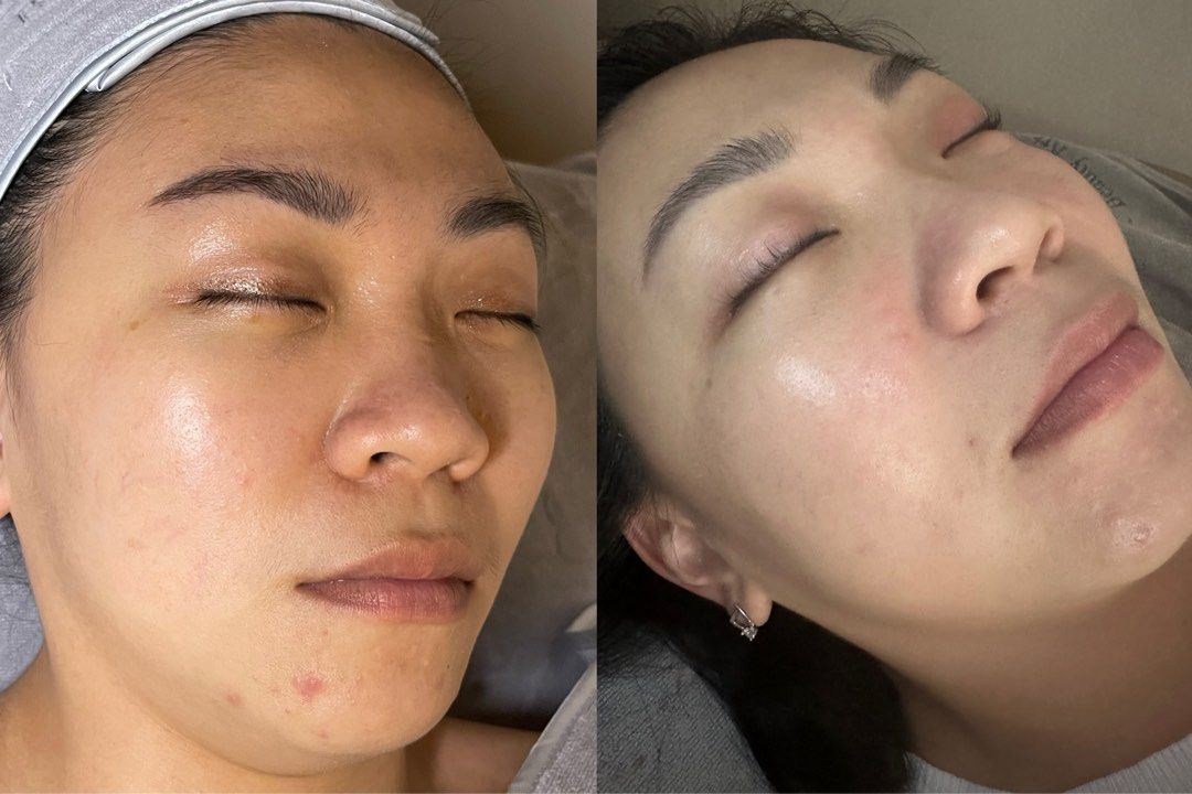 BB Glow Treatment 🤍 (Category: Beauty & Health Services) located in Singapore. Submitted by labellebeauty (Listing ID 1258503268, Image 2). Description: The BB Glow treatment is a cosmetic procedure that uses a semi-permanent tinted moisturizer adjusted to your skin tone to give the skin a flawless, even-toned appearance. It is designed to be waterproof, so it can provide long-lasting coverage and hydration for the skin. Benefits of the BB Glow 