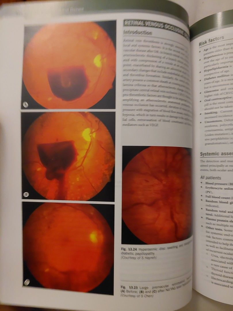 Kanski's Clinical Ophthalmology, 9th Ed, Hobbies & Toys, Books ...
