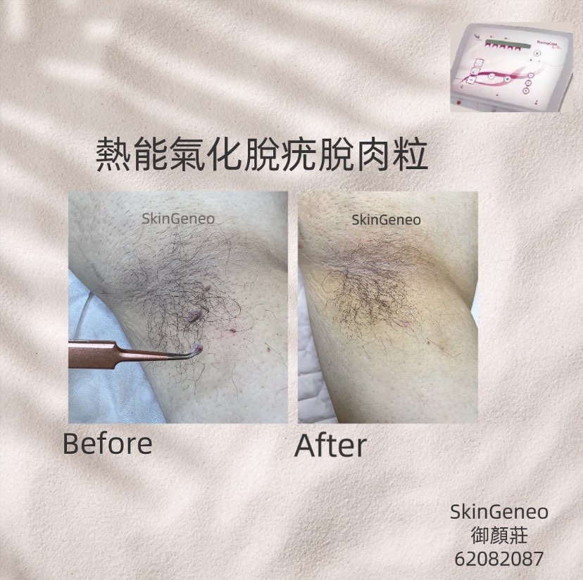 （分類：）位於 。 由 skingeneo62082087 提交（商品編號 1271746636，圖片 1）。簡介： 。
