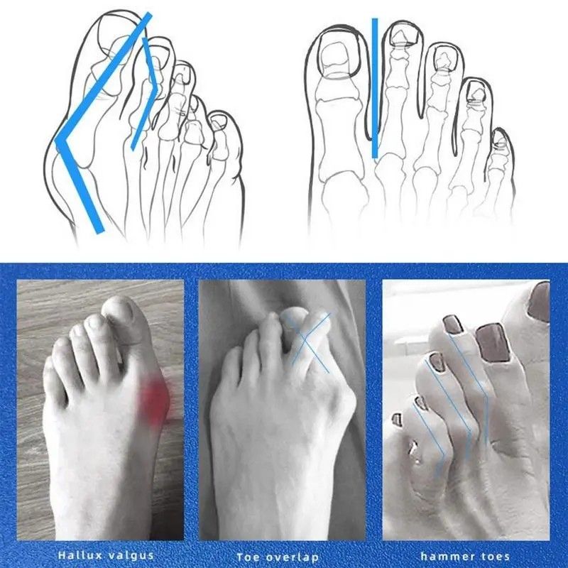 1 Pair Original Toe Straightener Bunion Separator Bone Corrector Relief  Pain Foot Valgus *$8.90, Beauty & Personal Care, Foot Care on Carousell
