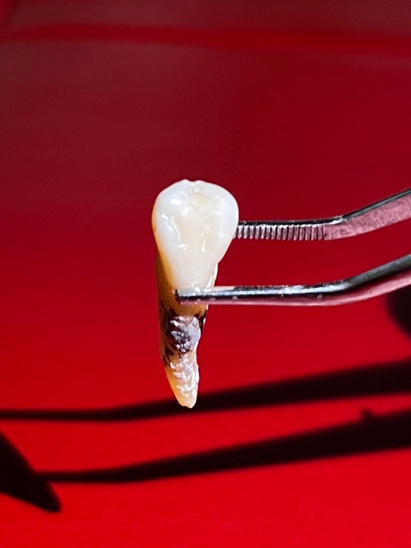 Natural Teeth (Category: Medical Supplies & Tools) located in Taguig. Submitted by mafrd (Listing ID 1214456190, Image 2). Description: P200 each Natural teeth Anteriors Premolars.