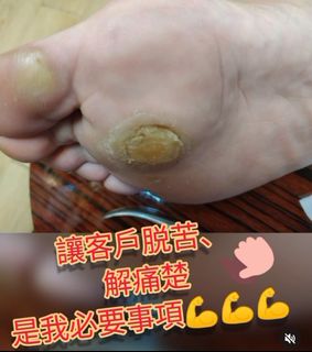 嚴重腳部護理雞眼64195859171714110