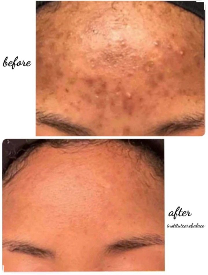 Image showcasing How to Reduce Acne Inflammation - Our Everyday Life