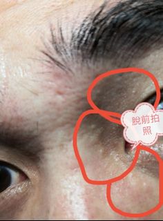 Sebaceous cysts, sebaceous glands, warts, sweat duct tumors ~ Men's face (photo taken 3 weeks after removal)64246534151555110