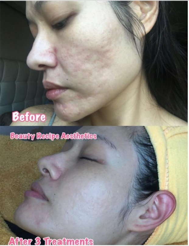 Stem Cell DNA / Fractional RF Microneedling / Plasma Repair Acne Scars ...