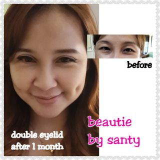Double eyelid discount surgery singapore