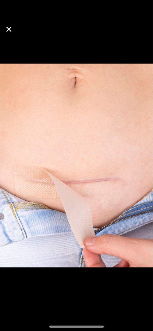SILICONEFUSION™ C-Section Scar Kit