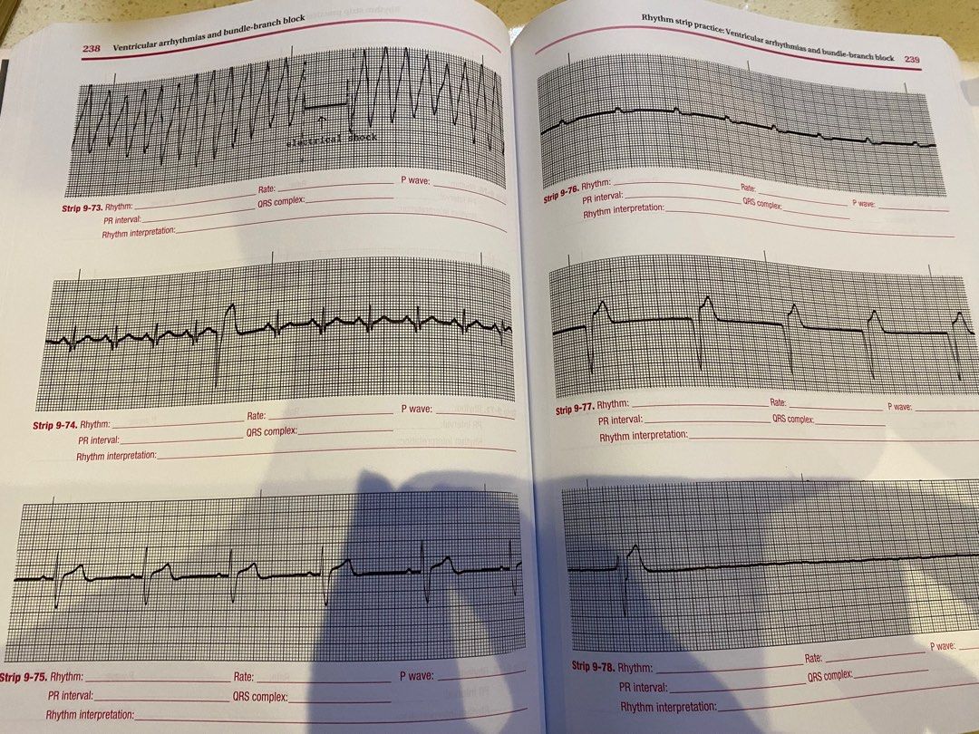 Positive Exercise Ecg Example ECG Workout: Exercises in Arrhythmia Interpretation, Hobbies & Toys ...
