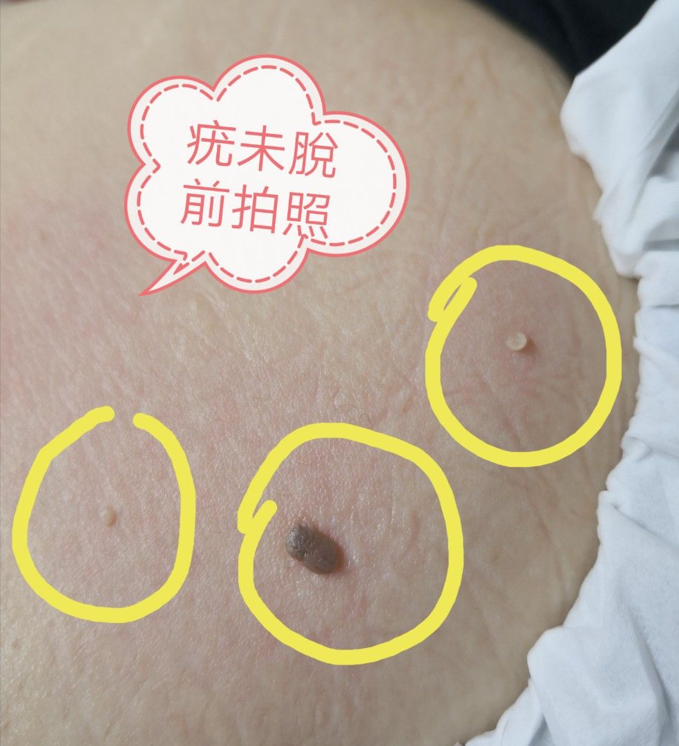 脫疣 肉粒~女士腰部, 美容＆化妝品, 健康及美容 - 皮膚護理, 面部 - 面部護理 - Carousell