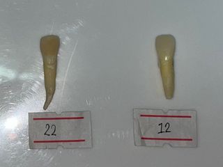Natural Tooth #12 & #22