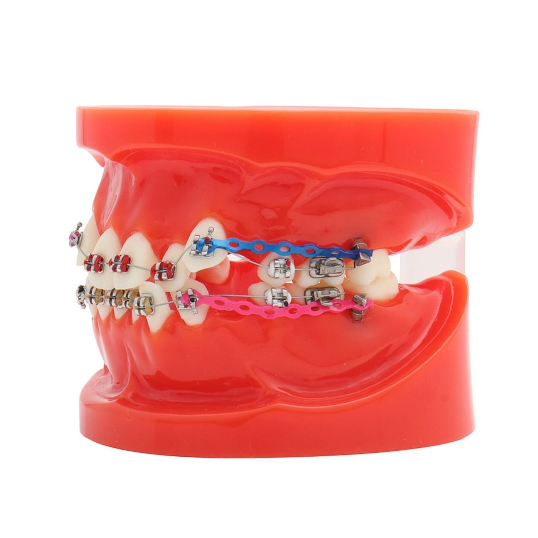 Dental Orthodontic Treatment Teeth Model Malocclusion Correction With