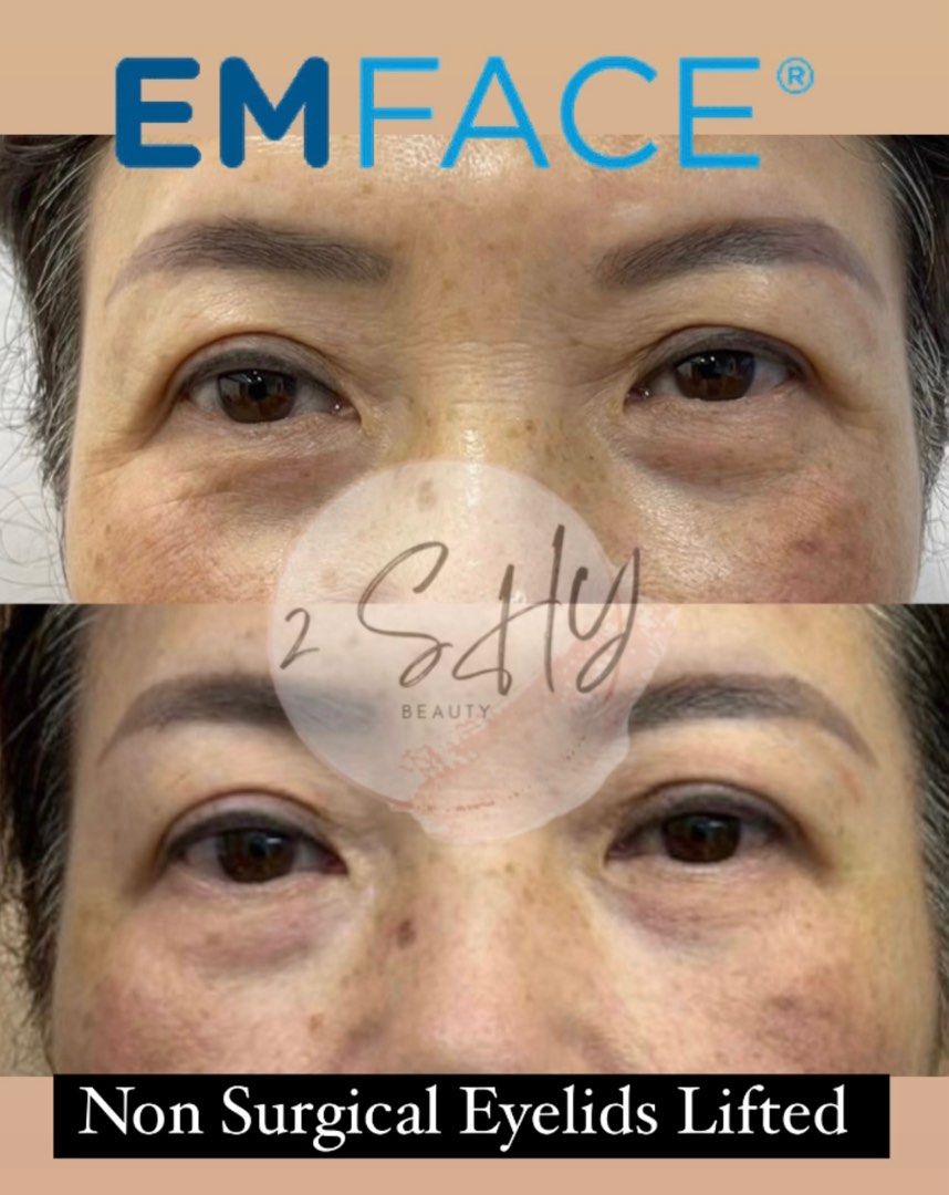 Authentic Emface ™ (non surgical face lift, eyelids lift, wrinkle  reduction, muscle toning, adjust asymmetrical face, V shape face, lighten  smiling line, collagen reproduction, double chin reduction FDA approved,  Lifestyle Services,