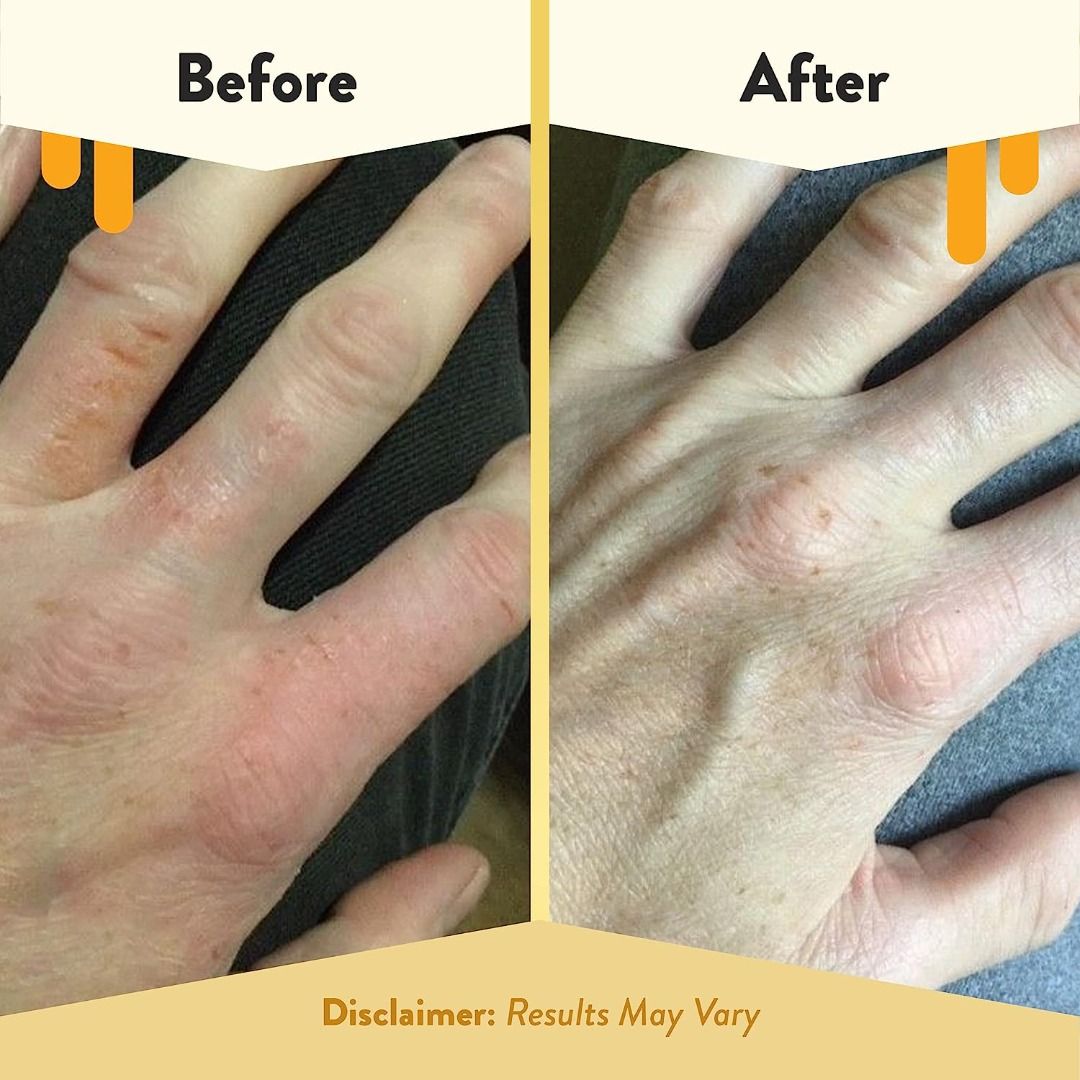 Eczema Honey Oatmeal Hand Cream - Natural Hand & Body Lotion for Eczema ...