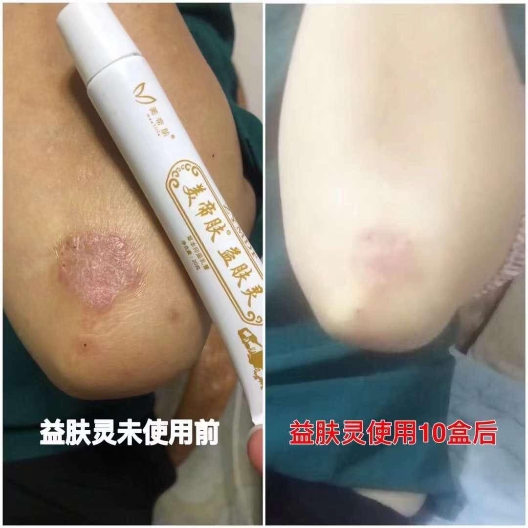 美帝肤益肤灵anti fungal psoriasis eczema sensitive skin ekzema