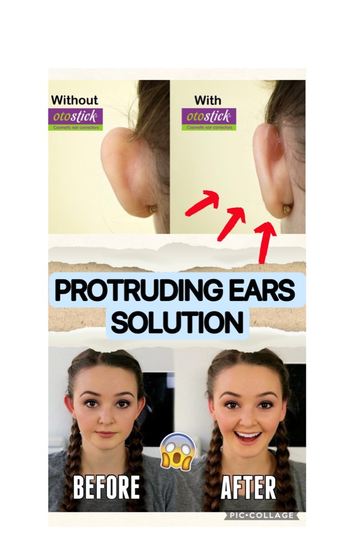 Otostick Baby Aesthetic Discreet Ear Corrector for Prominent Ears