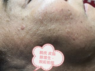 皮脂腺增生 疣~男士面部 (脫後一個月對比)64216659513603110
