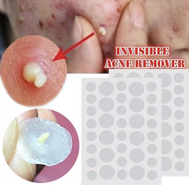 Pimple Patch/Acne Patch (Category: Face Care) located in Quezon City. Submitted by preciouszeronenine (Listing ID 1251857626, Image 1). Description: Pimple Patches / Acne Treatment to prevent bacteria. 36 patches Waterproof 36months Shell life Anti Bacteria . Rapidly absorb wound exudate. Suitable for those prone to Acne/Pimples .
