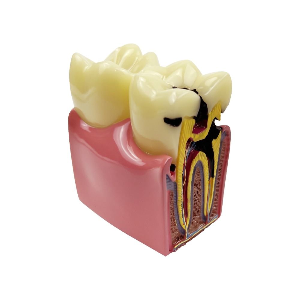 Dental Lab Caries Comparsion Models Decay Anatomy Teeth Model for ...