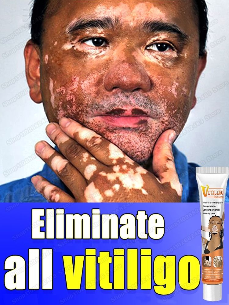 Gallery Detail: Effectively Remove Vitiligo Ointment Remove Ringworm White Spot Removal