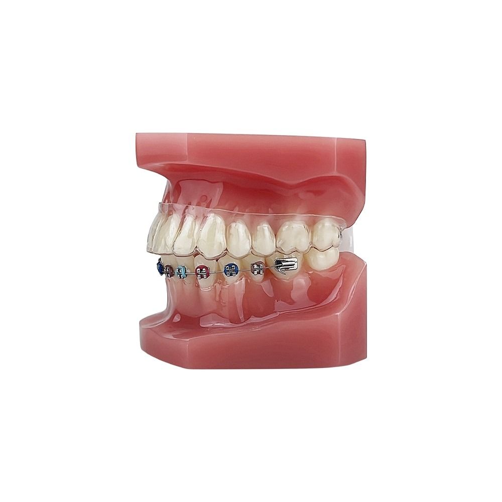 Dental Orthodontic Teeth Model With Braces Orthodontic Model Teeth ...