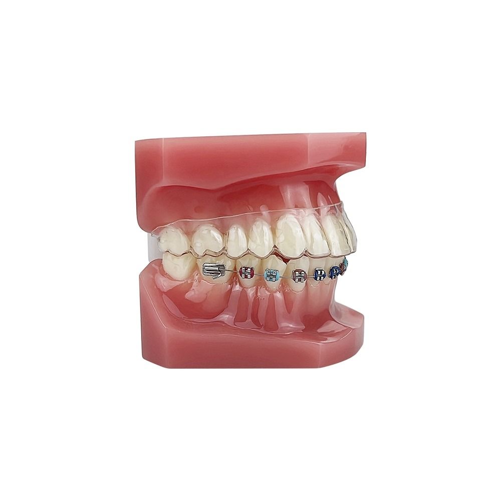 Dental Orthodontic Teeth Model With Braces Orthodontic Model Teeth ...