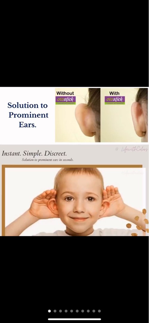 Protruding ears corrector Otostick, Beauty & Personal Care, Face