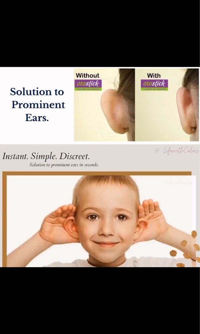 otostick - Otostick! Prominent ear solution that is discreet no