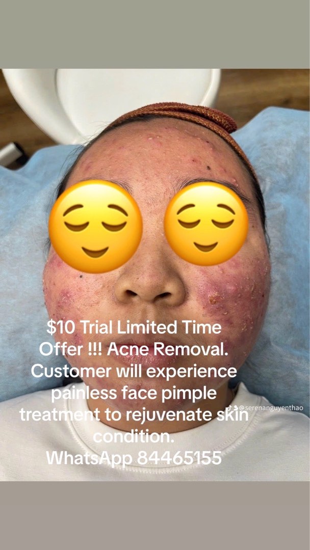 Acne Removal, Beauty & Personal Care, Face, Face Care on Carousell