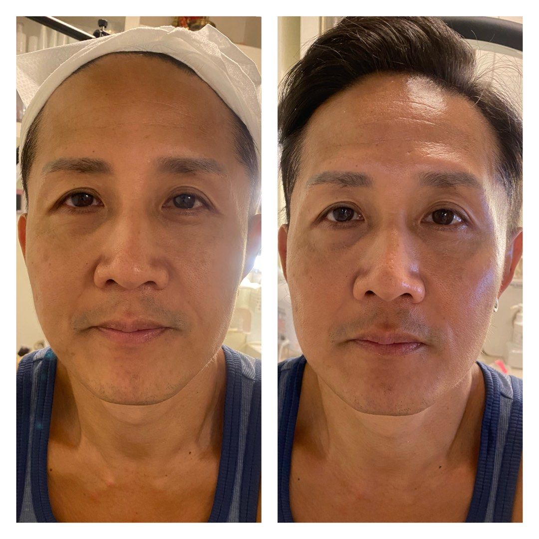 Latest non invasive jawline sharpening, face lifting , rejuvenation
