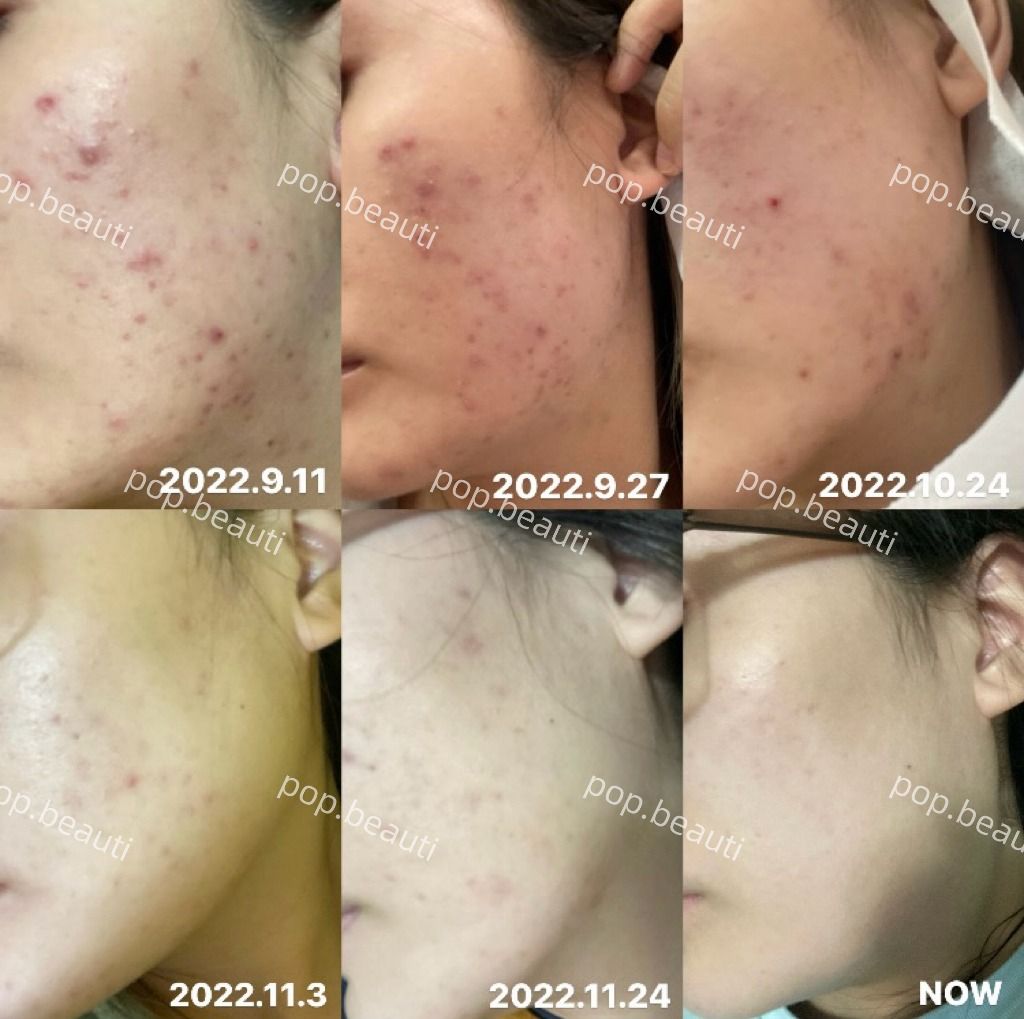 暗瘡斷尾💎美容院專用· 韓國Ronas蠶絲面膜🤍降紅修復款(銀蠶)🤍, 美容＆個人護理, 健康及美容- 皮膚護理, 面部- 面部護理-  Carousell