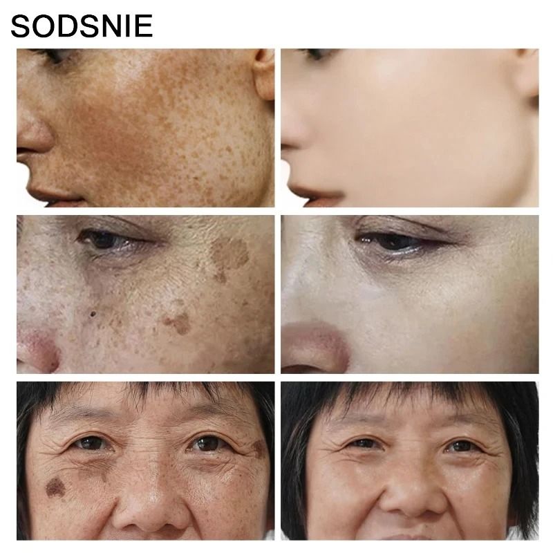 Dark Spot Remover Vitamin C Whitening Remove Melasma Freckle Sun Spots