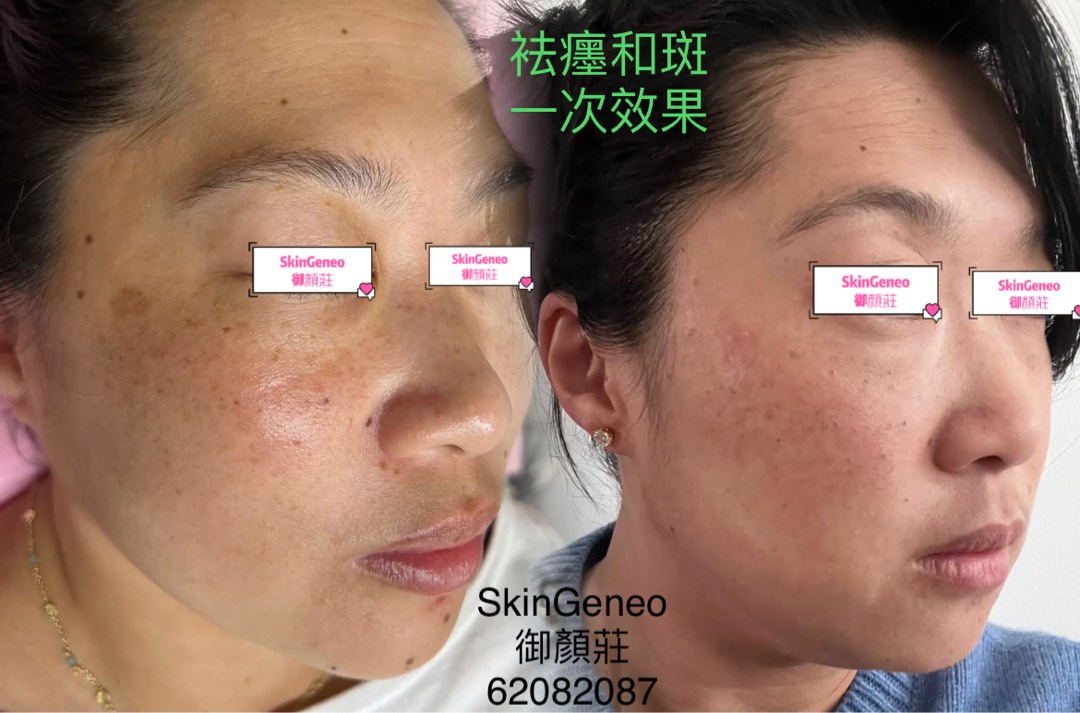 （分類：）位於 。 由 skingeneo62082087 提交（商品編號 1289004267，圖片 1）。簡介： 。