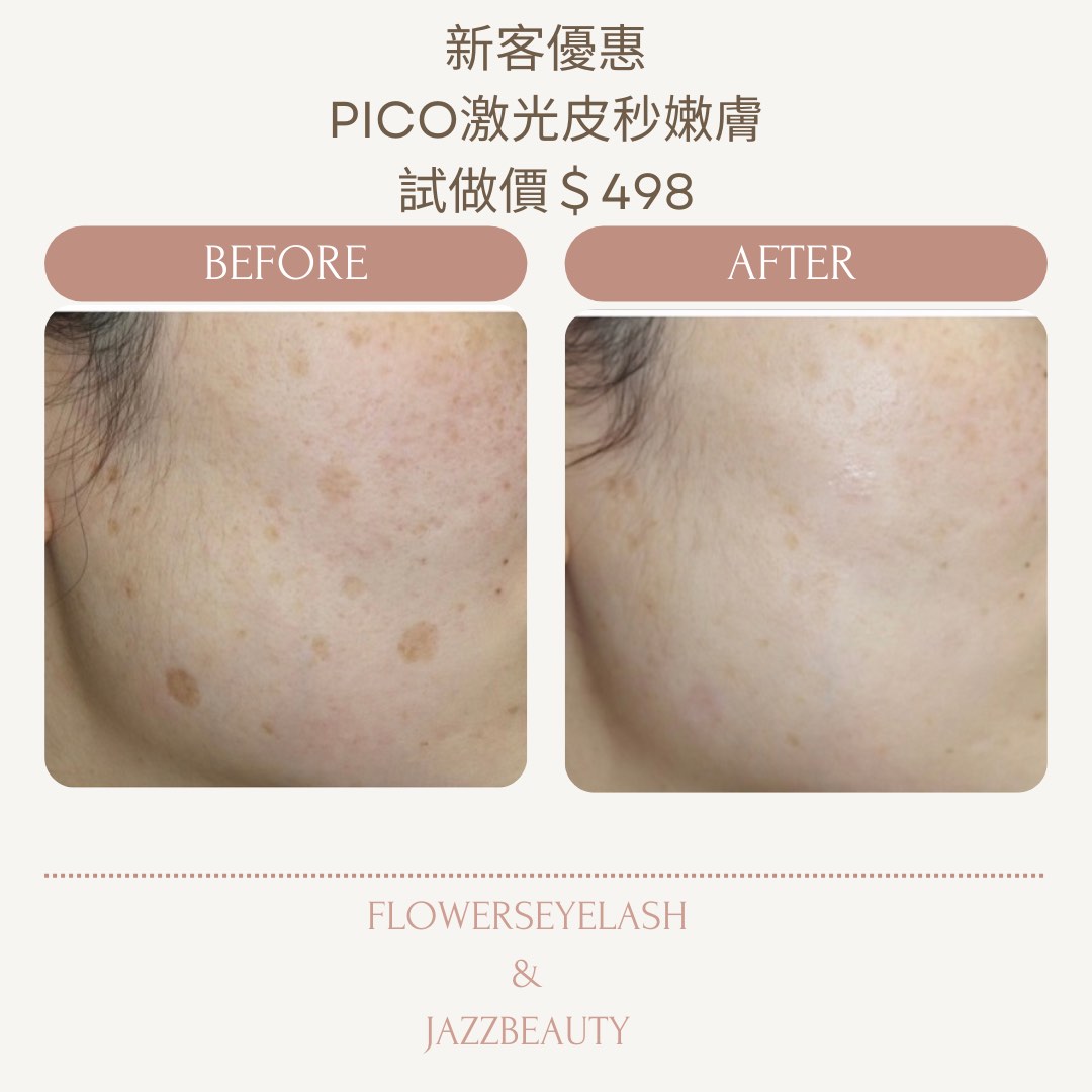 Pico Laser皮秒激光嫩膚去斑療程, 美容&個人護理, 健康及美容 - 皮膚護理, 面部 - 面部護理 - Carousell