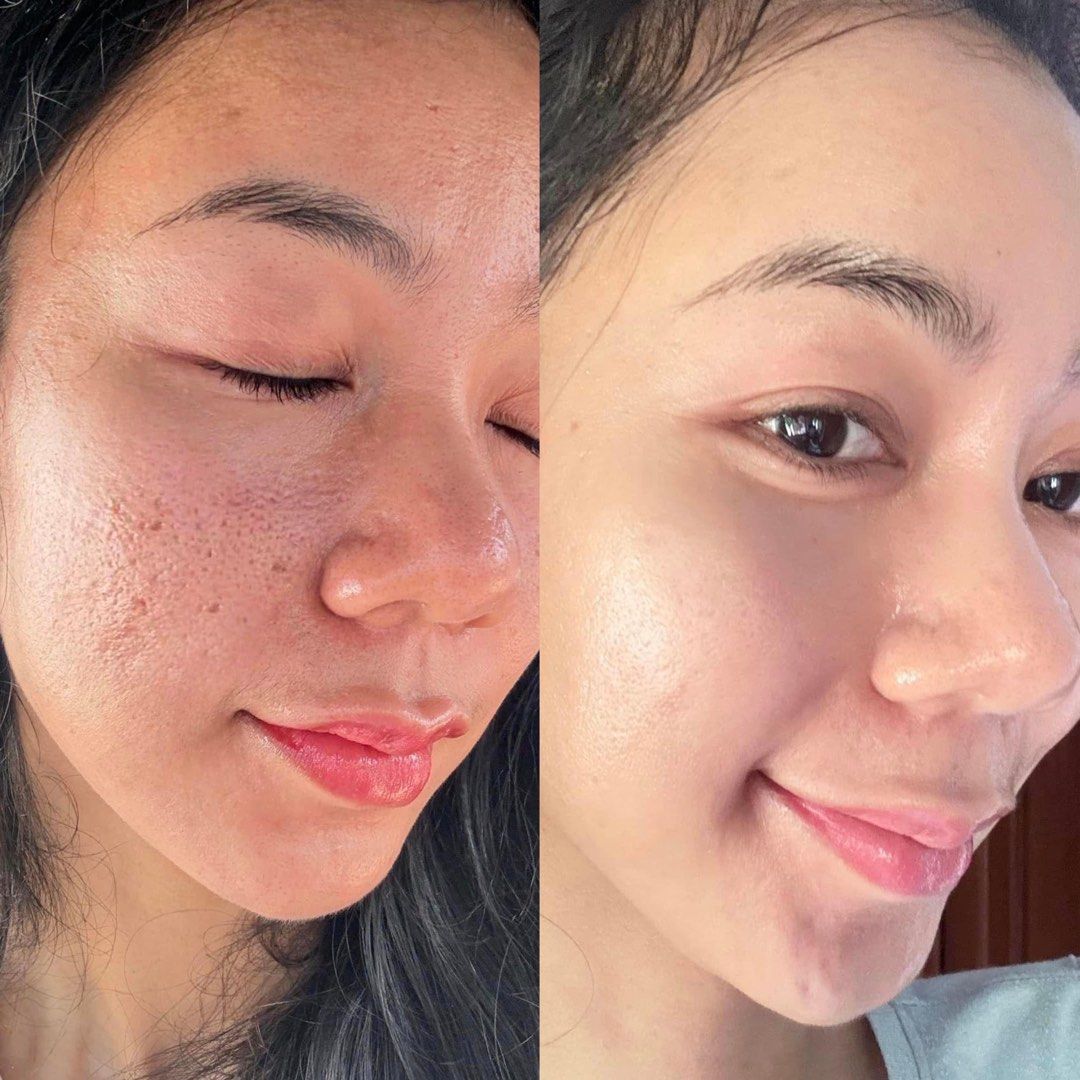 Facial - Micro needling - BB glow Clementi (Category: Beauty & Health Services) located in Singapore. Submitted by tenshimakeup.sg (Listing ID 1296777615, Image 1). Description: 📌BASIC FACIAL : 48$ (7 step) ( 45 minutes) Double wash - Scrub-steamer-extraction- massage face -mask 📌HYDRATING FACIAL: 60$( 8steps)( 70 minutes) - Double clean- scrub-steamer machine - aqua peel -hydrating ( with machine ) - massage face - mask - biological light mach