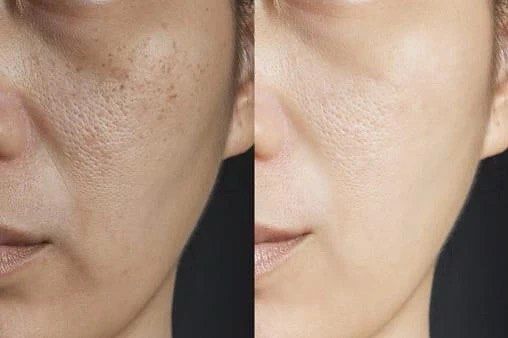 Facial - Micro needling - BB glow Clementi (Category: Beauty & Health Services) located in Singapore. Submitted by tenshimakeup.sg (Listing ID 1296777615, Image 2). Description: 📌BASIC FACIAL : 48$ (7 step) ( 45 minutes) Double wash - Scrub-steamer-extraction- massage face -mask 📌HYDRATING FACIAL: 60$( 8steps)( 70 minutes) - Double clean- scrub-steamer machine - aqua peel -hydrating ( with machine ) - massage face - mask - biological light mach