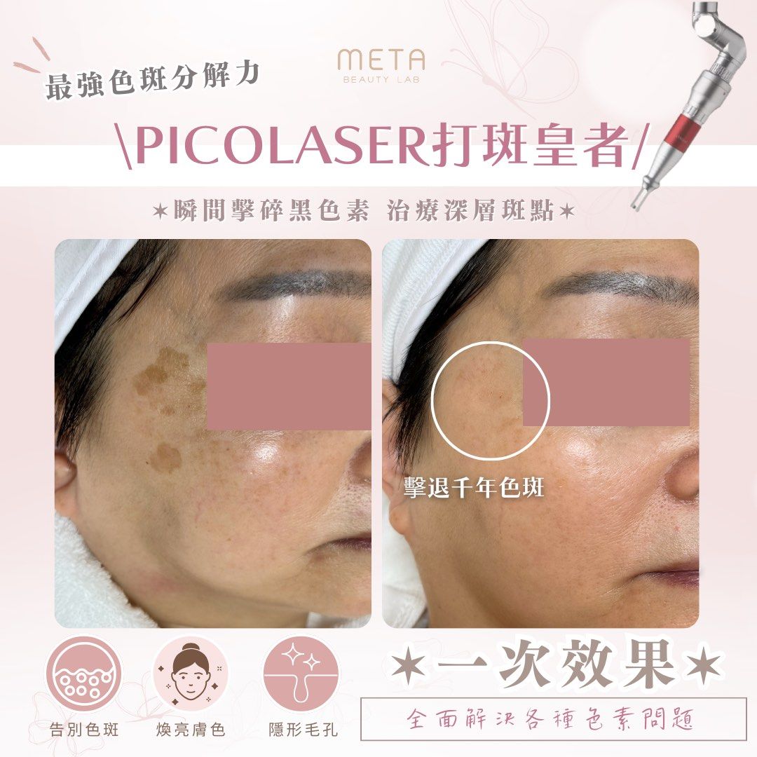 Pico Laser 皮秒激光起焦 一次清 去斑 曬斑 雀斑 結焦 荷爾蒙斑 色斑, 美容&個人護理, 健康及美容 - 皮膚護理, 面部 ...