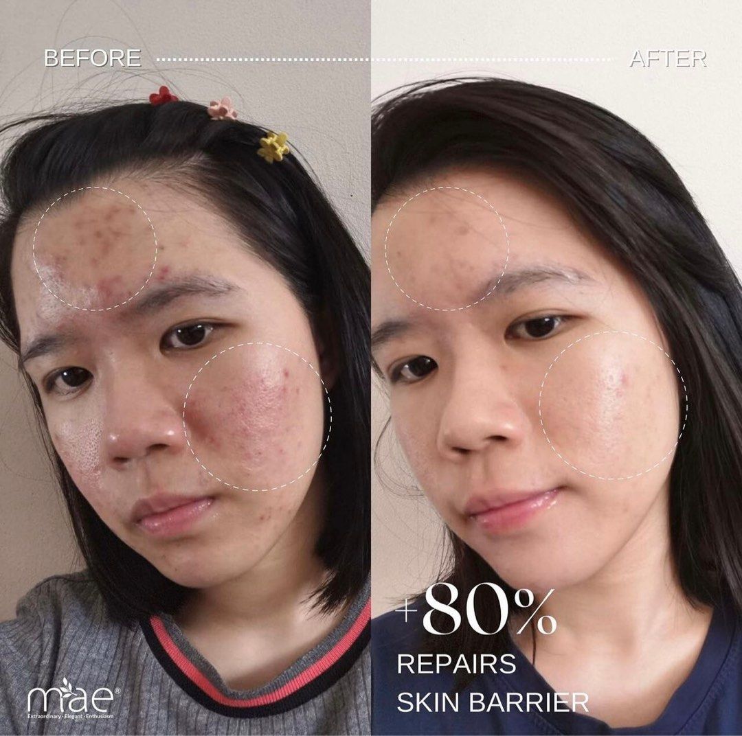 專治暗瘡敏感爛面Clarity mask 面膜, 美容＆個人護理, 健康及美容- 皮膚護理, 面部- 面部護理- Carousell