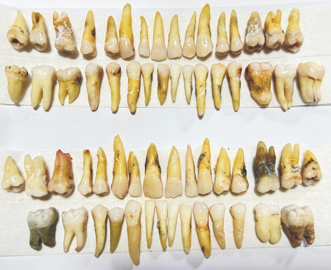 Natural Tooth (Category: Medical Supplies & Tools) located in Manila. Submitted by abubotatbp (Listing ID 1284121609, Image 1). Description: No return/ No exchange of item What you see is what you get Can take a close picture of the teeth No reservations Set will be prioritized!!! P2,800 per set P800 per quadrant P100/each Anterior teeth (central, lateral, canine, premolars) P150/each Birooted Premolar good for endo P250/each Maxillary and Mandib