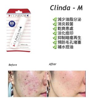 現貨:泰國暗瘡水(Clinda-M) 15ml 64215710401667110