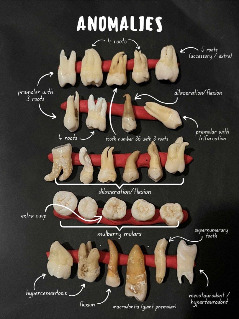 NATURAL TOOTH WITH ANOMALIES (Category: Medical Supplies & Tools) located in Malolos. Submitted by savesab (Listing ID 1393849708, Image 1). Description: FOR SALE: NATURAL TOOTH WITH ANOMALY (ABNORMAL/PATHOLOGIC) 🦷 - Extra (Accessory) Root - Mulberry Molars (Hutchinson's) - Mesotaurodontism / Hypertaurodontism - Hypercementosis - Dilaceration / Flexion - Extra (Accessory) Cusp - Supernumerary / accessory tooth - Macrodontia.