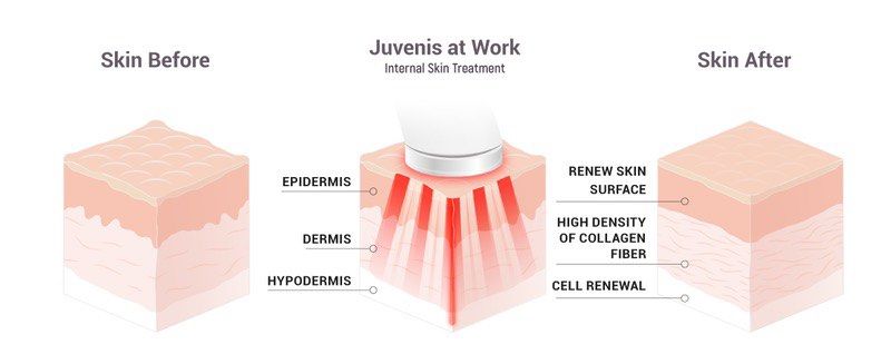 Anti Aging JUVENIS By Zero Gravity (Category: Face Care) located in Manila. Submitted by snowjemfri62047 (Listing ID 1390626208, Image 3). Description: Juvenis By ZeroGravity Company from Florida USA Original Price: PHP 69,700 Negotiable Never been use Description : Anti-aging: Reducing fine lines and wrinkles. Skin Tone & Texture: Improving dull complexions, uneven pigmentation, and sun-damaged skin. Age & Dark Spots: Fading the appearance of ag