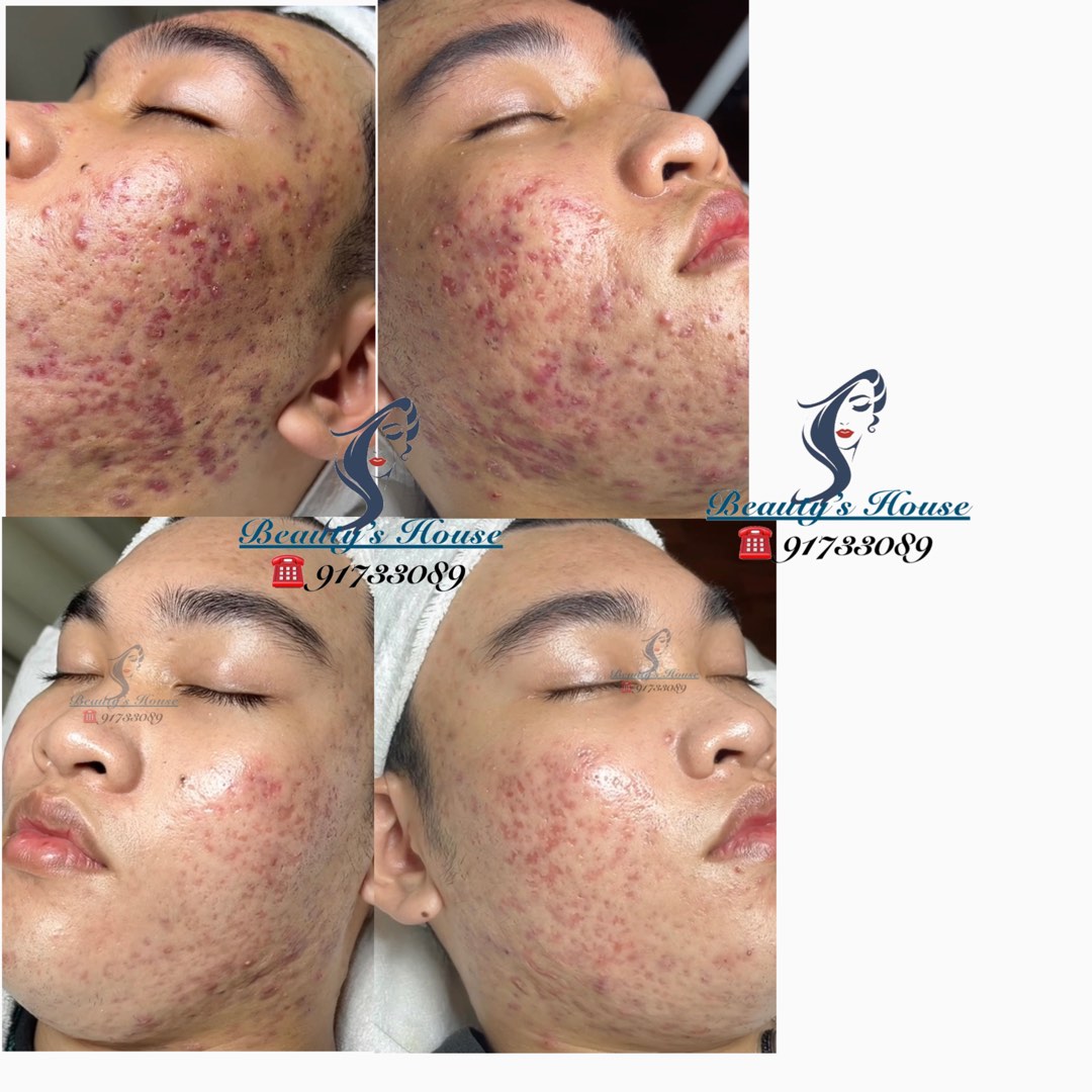 Beauty's House Acne Facial Treatment Services, Beauty & Personal Care ...