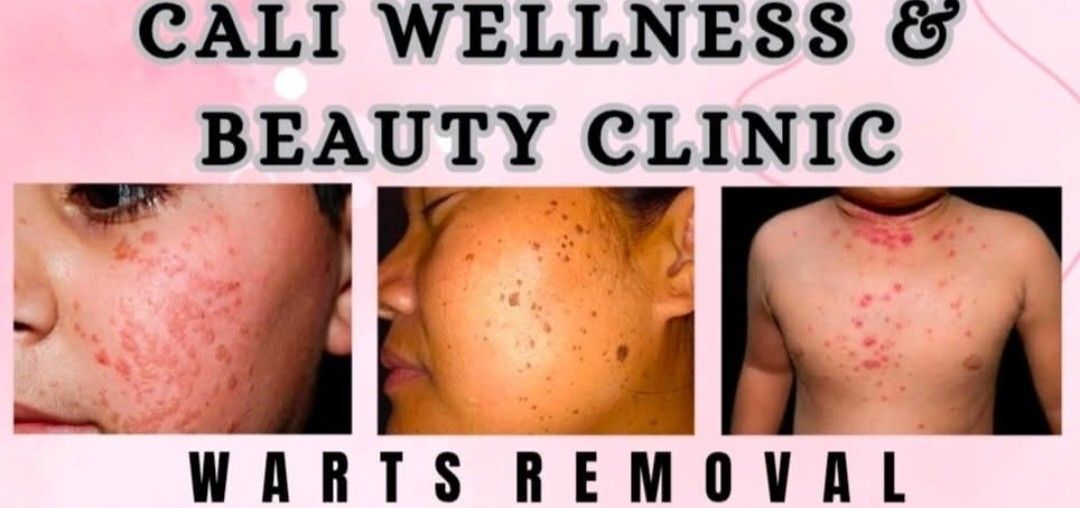 Warts Removal (Category: Face Care) located in Quezon City. Submitted by allonsale991983 (Listing ID 1465749082, Image 1). Description: Promo Unlimited small warts removal for only 999 per area By appointment only Location: Cubao QC Wart removal can have several benefits — both medical and cosmetic. Here’s a clear breakdown: 1. Prevents spread Warts are caused by the human papillomavirus (HPV), which is contagious. Removing them helps Reduce the 