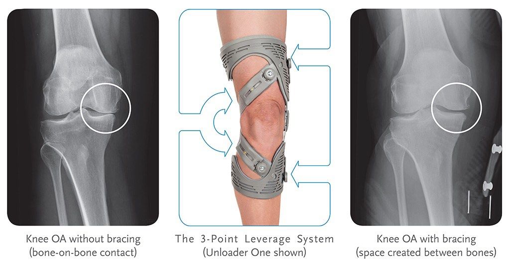Ossur Knee Under Sleeve / Support / Correction (Gray - Medium Size) (Category: Braces, Support & Protection) located in Calamba. Submitted by minminsio0011 (Listing ID 1377800949, Image 1). Description: .