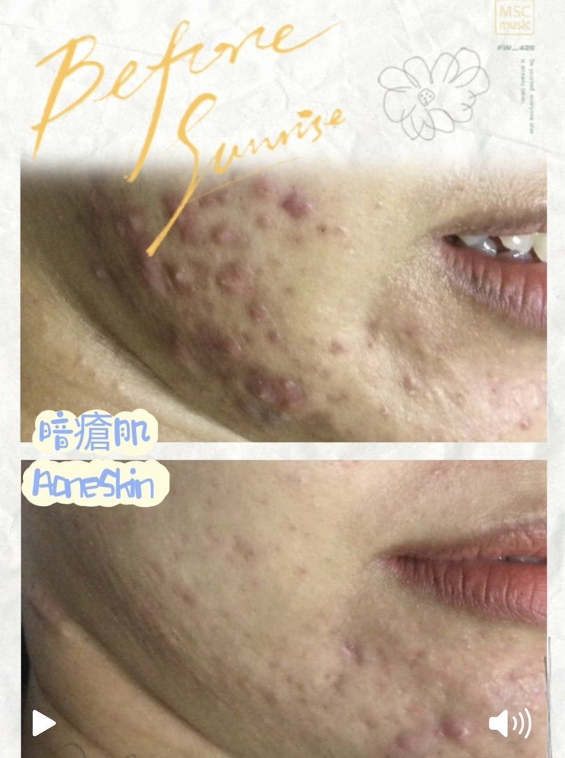 laser Facial （分類：美容服務）位於 Hong Kong。 由 skingeneo93313413 提交（商品編號 1280725693，圖片 1）。簡介： 客人皮膚經常生石頭瘡，揾過好多方法都解決唔到暗瘡問題，試做咗laser後感覺暗瘡岀了很多，暗瘡亦淡了，皮膚生暗瘡亦少了很多，皮膚如果生得多暗瘡不及時處理會導致皮膚鬆弛和永久性凹凸洞。 🤩相片全為真實客人效果，沒有修圖。 Ig:skingeneo.hk 地址：灣仔駱克道382號莊氏企業大廈2301室 。