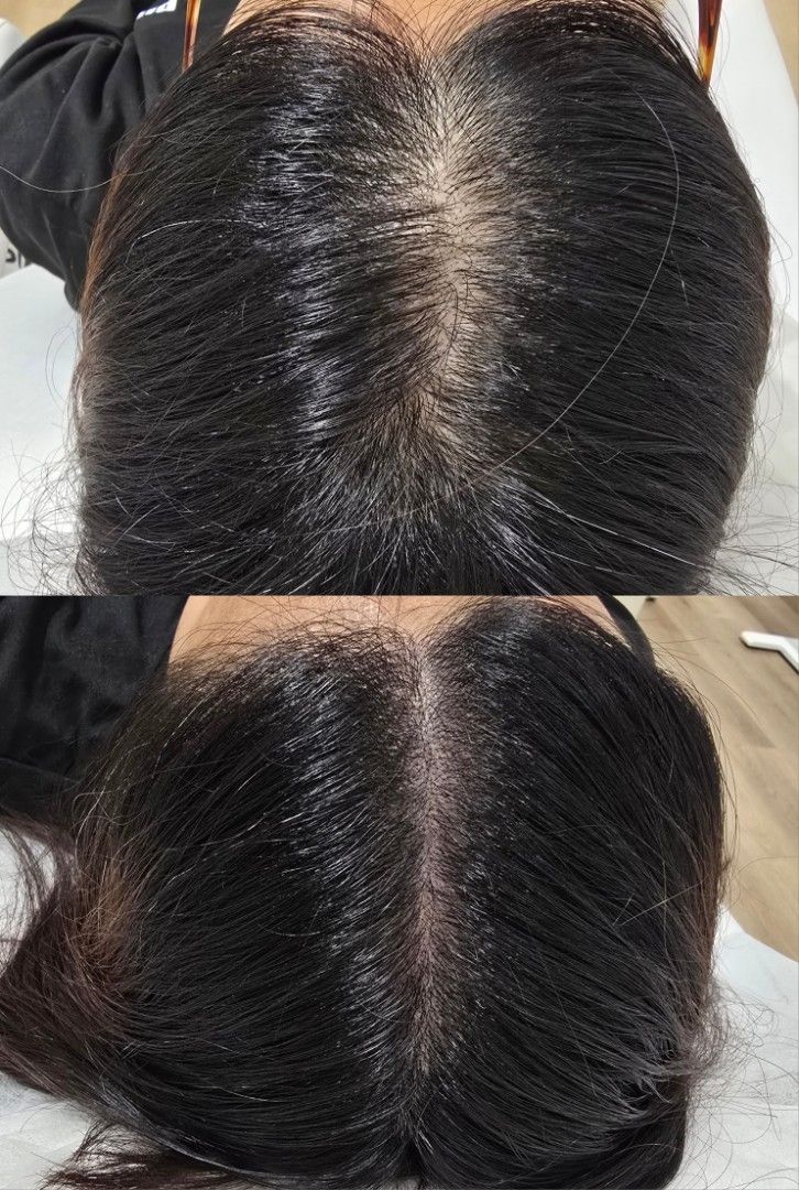 SMP Model Programme (Category: Hair) located in Singapore. Submitted by june._smp (Listing ID 1448029678, Image 2). Description: Achieve natural-looking, fuller hair with our SMP Portfolio Model Programme. - Session 1: Complimentary (free) - Session 2: $150 - Session 3: $150 (if required) - $50 booking deposit is required. - Deposit will be credited towards your 2nd session. - DM us to enquire and send photos for assessment..