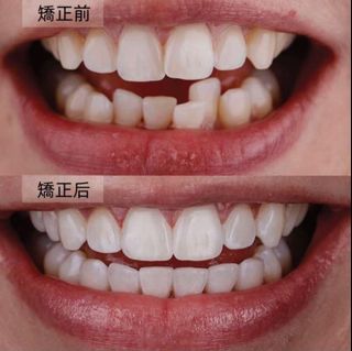 （分類：）位於 。 由 invisible.orthodontics 提交（商品編號 1460429911，圖片 1）。簡介： 。